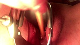 Cervix stretched wide open